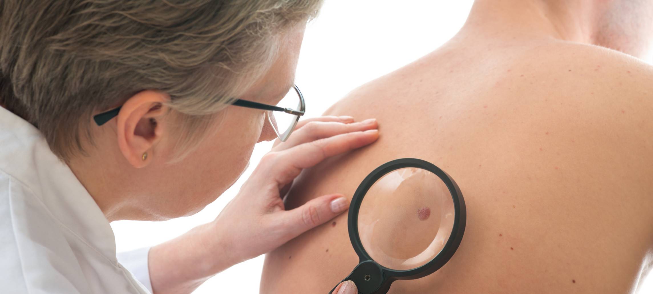 Erschreckend: Weniger Menschen bei Hautkrebs-Vorsorge